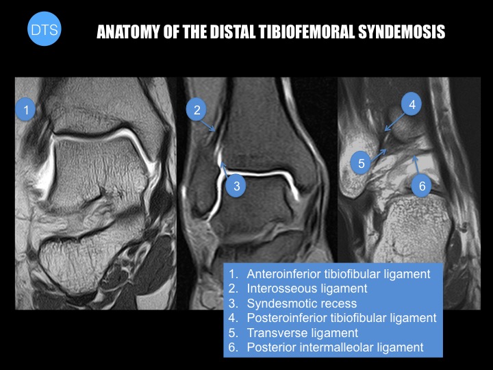 Figure 4 for case High ankle sprain Acute complete rupture of the syndemotic ligament complex
